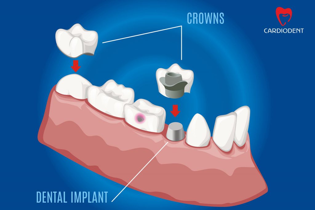 cardiodent implant dentar