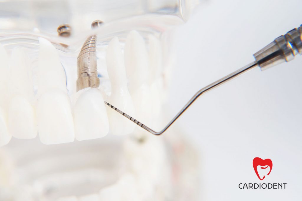 implant dentar accesibil