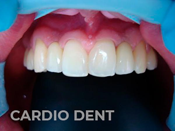 lp-dantura-fixa-after-4