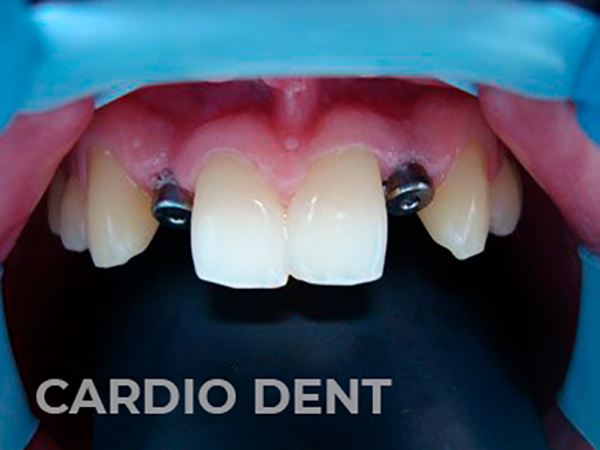 lp-dantura-fixa-before-4