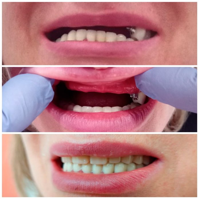 Caz clinic - Pacienta 53 ani - Boala parodontala avansata Caz clinic - Pacienta 53 ani - Boala parodontala avansata