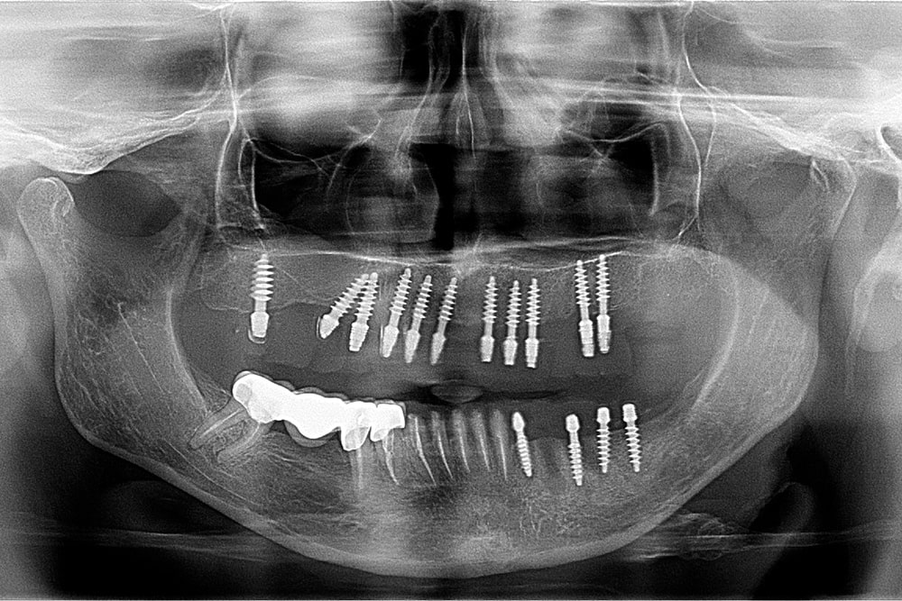 Caz Clinic - Pacientă 53 ani - Boală Parodontală Avansată 2 Caz clinic - Pacienta 53 ani - OPT dupa interventie