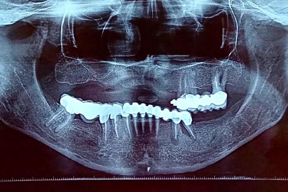 Caz Clinic - Pacientă 53 ani - Boală Parodontală Avansată 1 Caz clinic - Pacienta 53 ani - OPT inainte interventie