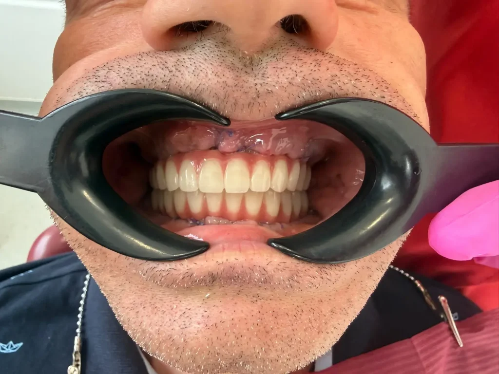 Studiu de caz: Reabilitare orală completă în doar 7 zile pentru un pacient de 53 de ani din Marea Britanie 7 caz pacient 53 ani reabilitare 7 zile lucrare protetica 2 cardiodent