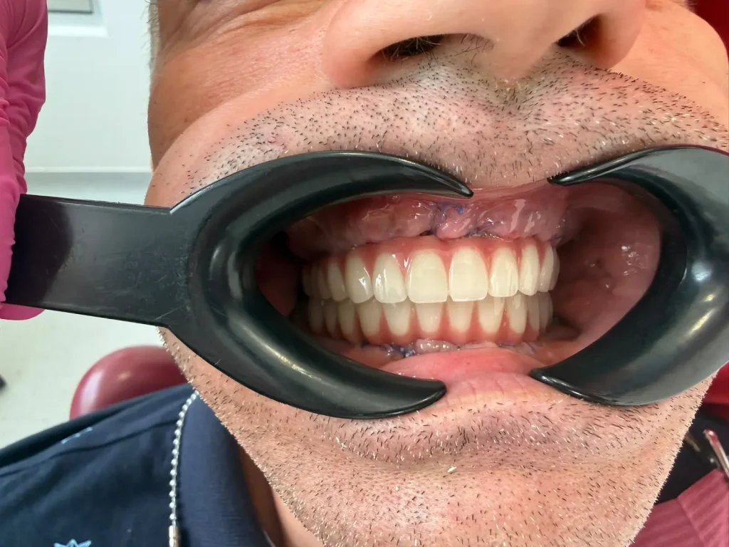 Studiu de caz: Reabilitare orală completă în doar 7 zile pentru un pacient de 53 de ani din Marea Britanie 6 caz pacient 53 ani reabilitare 7 zile lucrare protetica cardiodent