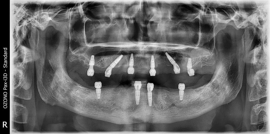 Studiu de caz: Reabilitare orală completă în doar 7 zile pentru un pacient de 53 de ani din Marea Britanie 5 caz pacient 53 ani reabilitare 7 zile ortopantomografie after cardiodent