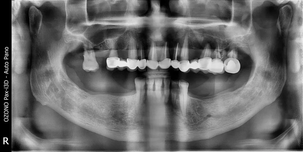 Studiu de caz: Reabilitare orală completă în doar 7 zile pentru un pacient de 53 de ani din Marea Britanie 1 caz pacient 53 ani reabilitare 7 zile ortopantomografie before cardiodent